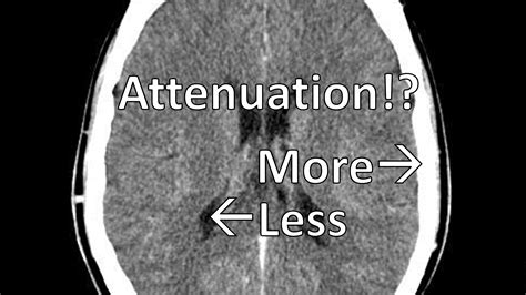 what does attenuation means.